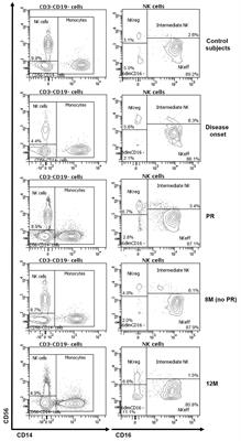 NK Cell Subsets Changes in Partial Remission and Early Stages of Pediatric Type 1 Diabetes
